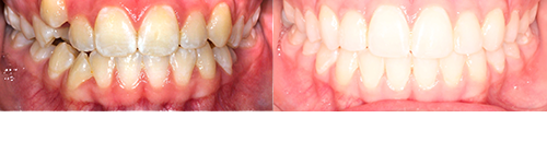Ab-Par-Frontal-BnA