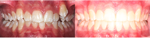 An-Hon-Frontal-BnA