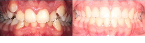 Em-Mon-Frontal-BnA
