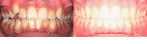 Kat-Ham-Frontal-Intraoral-BnA