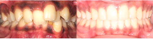 Tej-Frontal-BnA